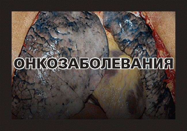 Минздрав опубликовал картинки для запугивания курильщиков