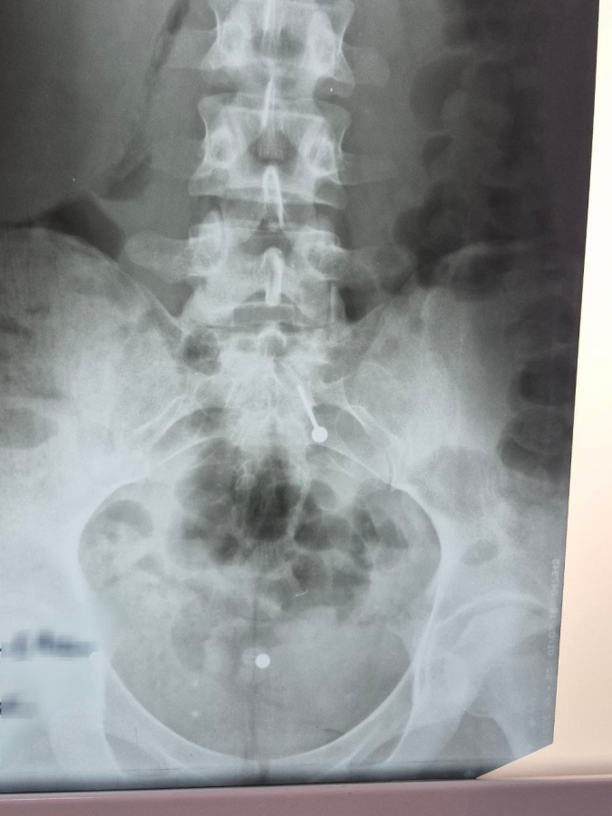 В Балакове девушка проглотила пирсинг во время еды и оказалась в больнице