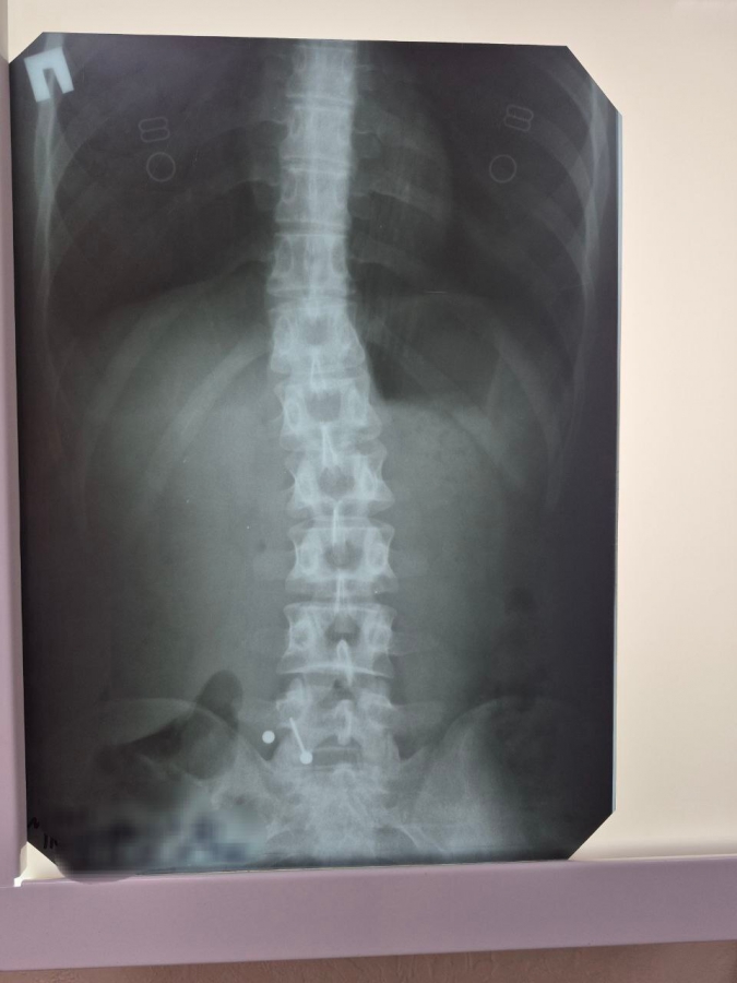 В Балакове девушка проглотила пирсинг во время еды и оказалась в больнице