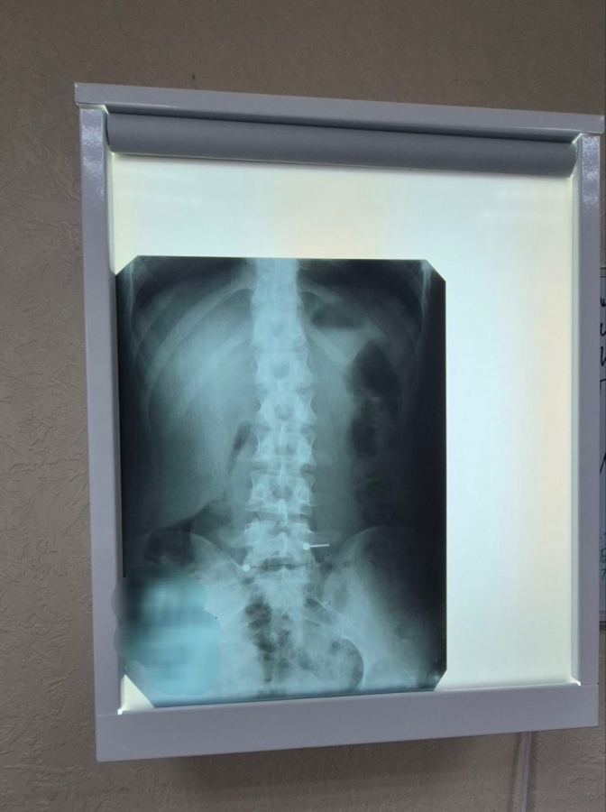 В Балакове девушка проглотила пирсинг во время еды и оказалась в больнице