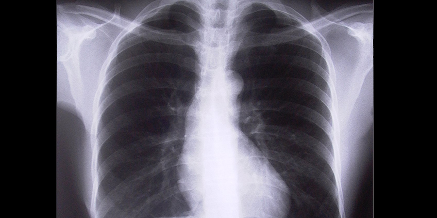 Саратовцы жалуются на очереди в рентген-кабинеты из-за неработающих аппаратов