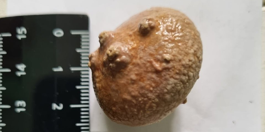Балаковские врачи достали из мочевого пузыря старика трехсантиметровый камень