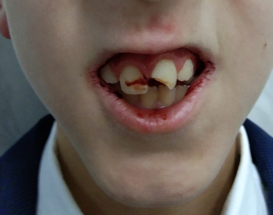 В Юбилейном начали проверку из-за жестокого избиения ученика 2-го класса в лицее