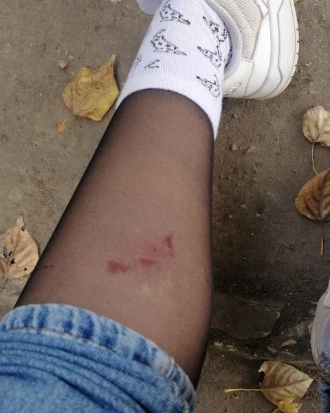 На Тархова собака покусала ребенка. В СУ СК начали проверку