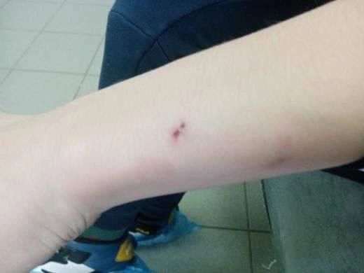 На Соколовой собака покусала ребенка. СК начал проверку