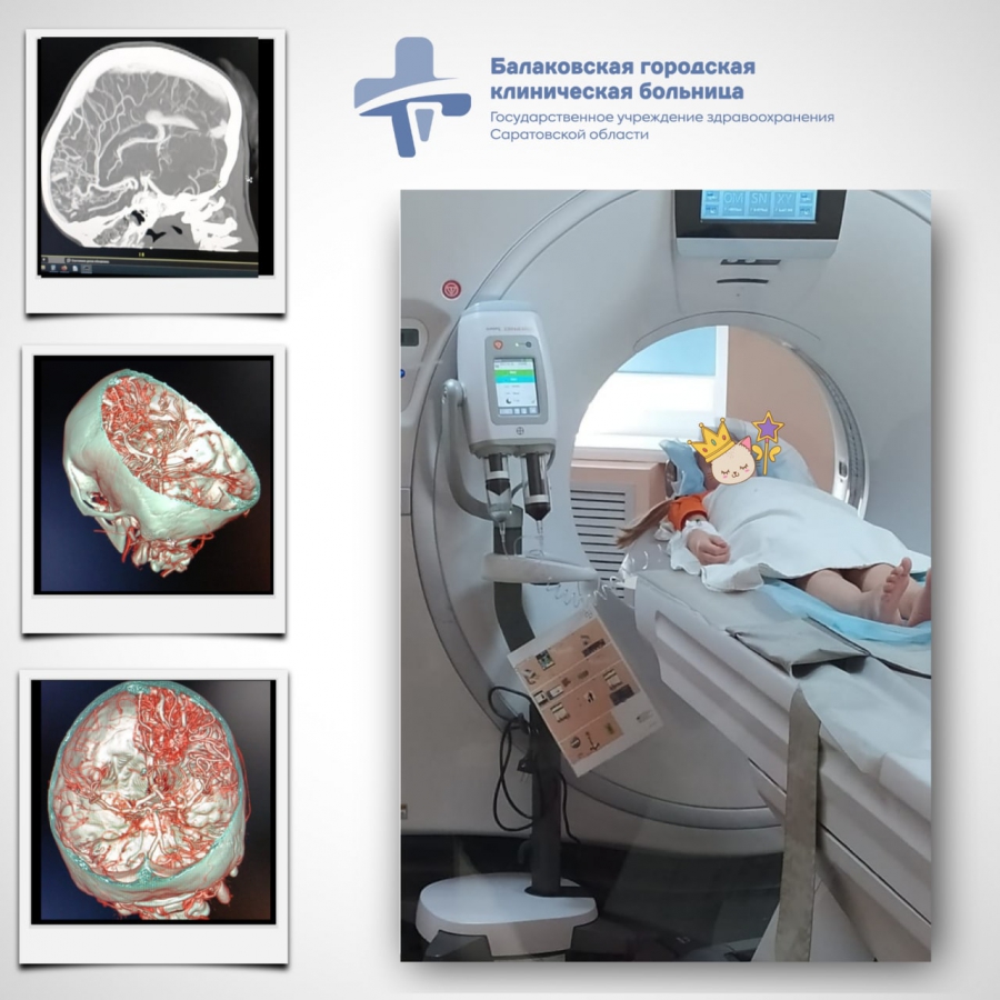 В Балакове медики провели уникальную процедуру на мозге ребенка