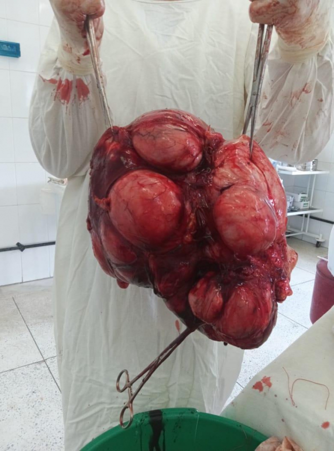 В Энгельсе медики прооперировали женщину с опухолью матки весом более 8 кг