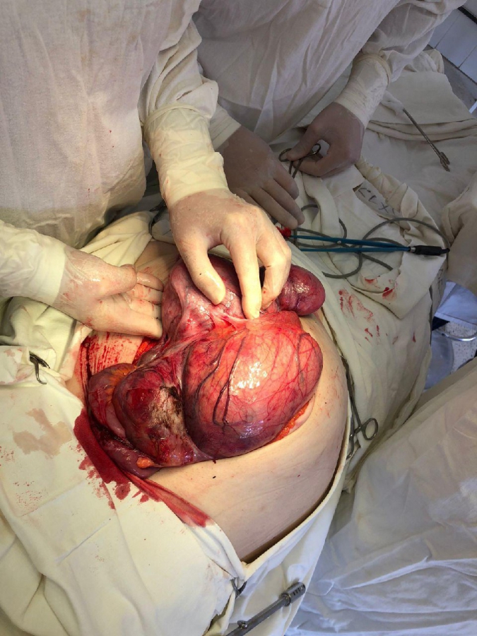 В Энгельсе медики прооперировали женщину с опухолью матки весом более 8 кг