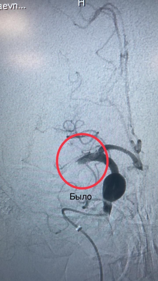 В больнице Саратова растет число операций эндоваскулярным методом при инсульте