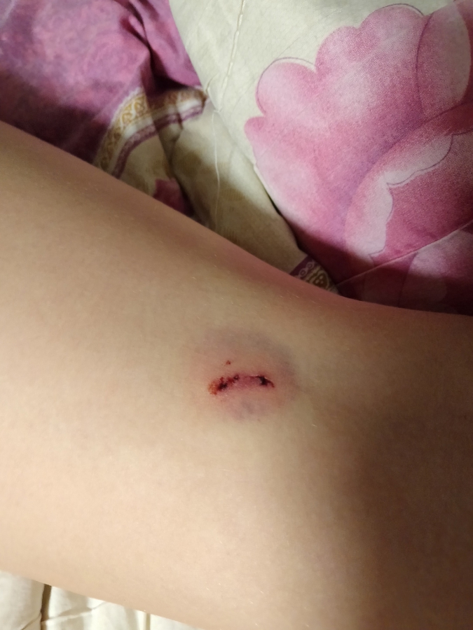 На Томской бродячая собака прокусила 9-летнему ребенку ногу