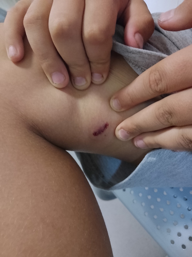 На Томской бродячая собака прокусила 9-летнему ребенку ногу