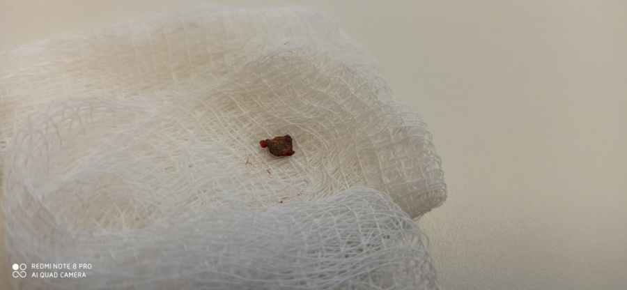 Хирург поликлиники в Саратове вытащил из плеча бойца СВО осколок снаряда