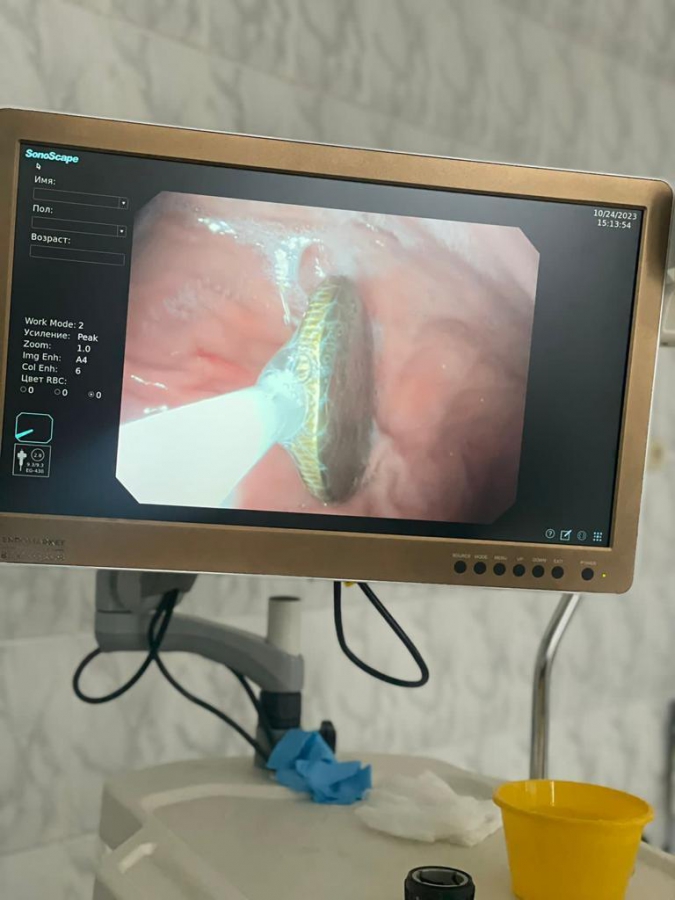 В Энгельсе врачи достали из желудка младенца рублевую монету