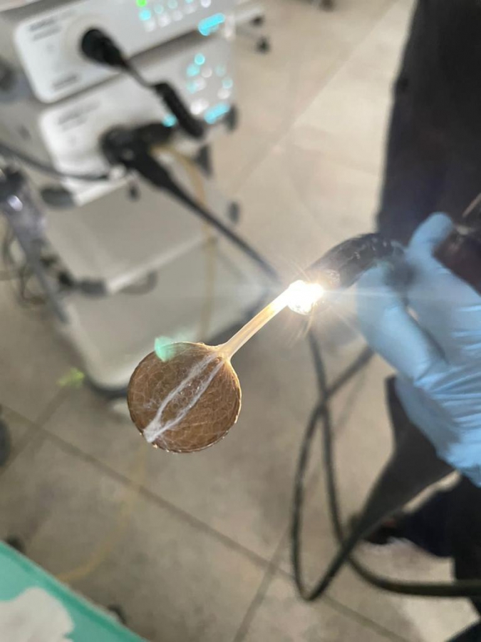 В Энгельсе врачи достали из желудка младенца рублевую монету