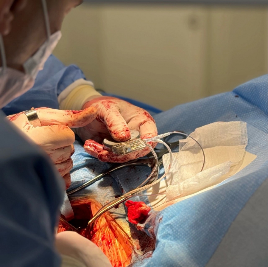 Саратовские врачи провели уникальную операцию с кардиовертером-дефибриллятором