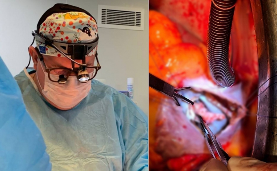 Саратовские врачи провели уникальную операцию и решили 3 проблемы с сердцем