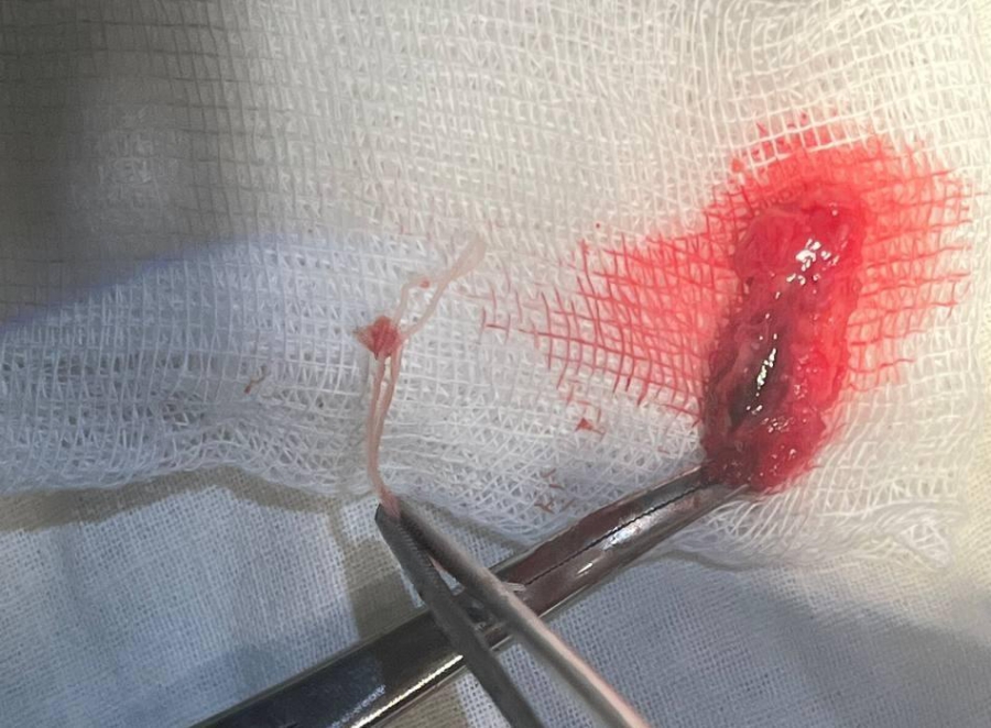 В Саратове врачи вытащили из лица горожанина червя-паразита длиной 12 см