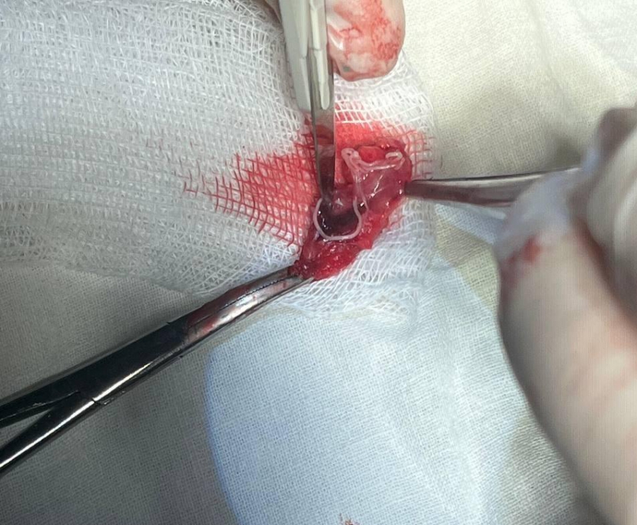 В Саратове врачи вытащили из лица горожанина червя-паразита длиной 12 см