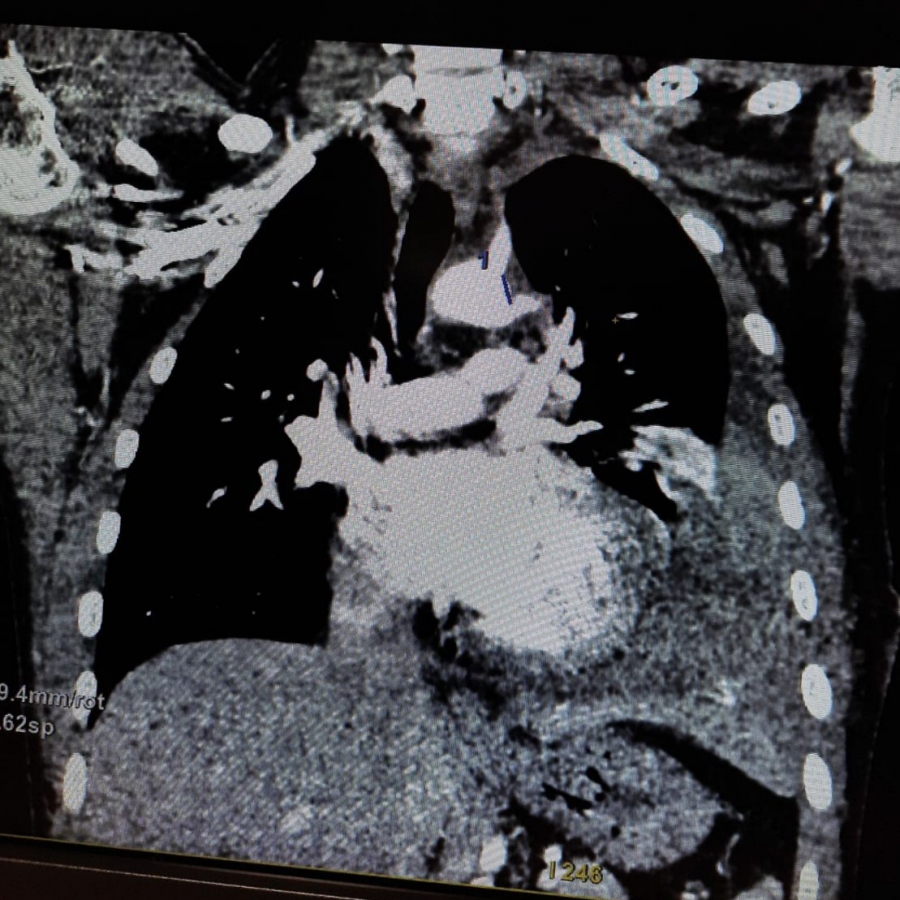 Саратовские врачи чудом спасли бойца СВО с осколочным ранением