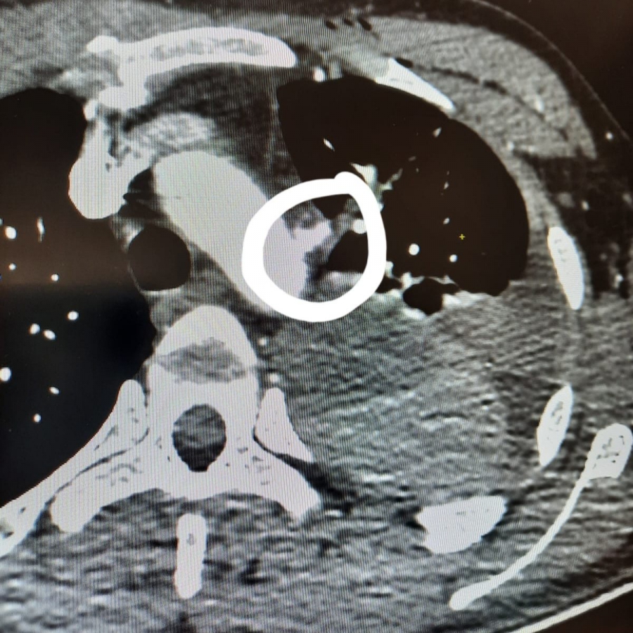 Саратовские врачи чудом спасли бойца СВО с осколочным ранением