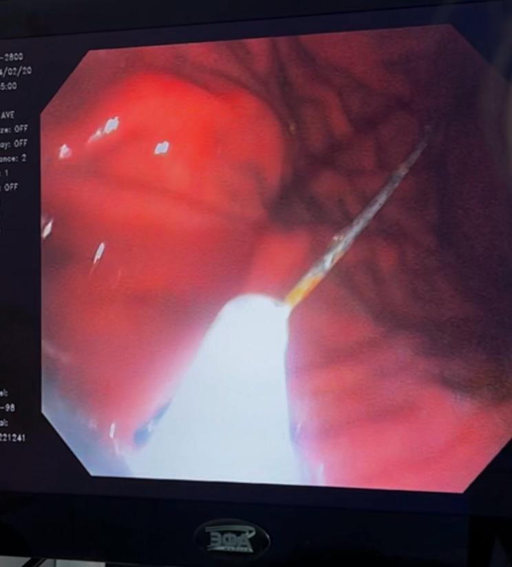 В Энгельсе врачи извлекли из желудка женщины швейную иглу