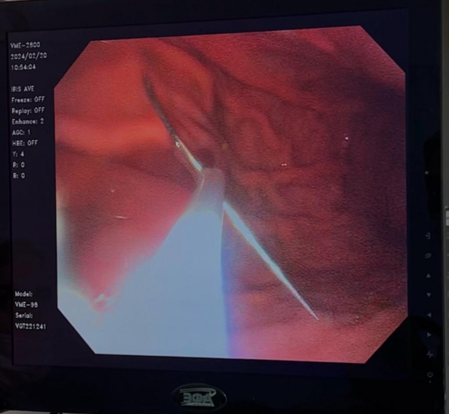 В Энгельсе врачи извлекли из желудка женщины швейную иглу