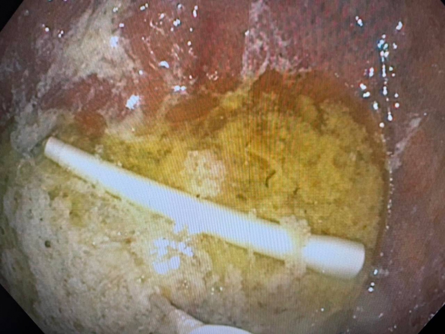 Саратовец проглотил трубку от ингалятора и попал на операционный стол