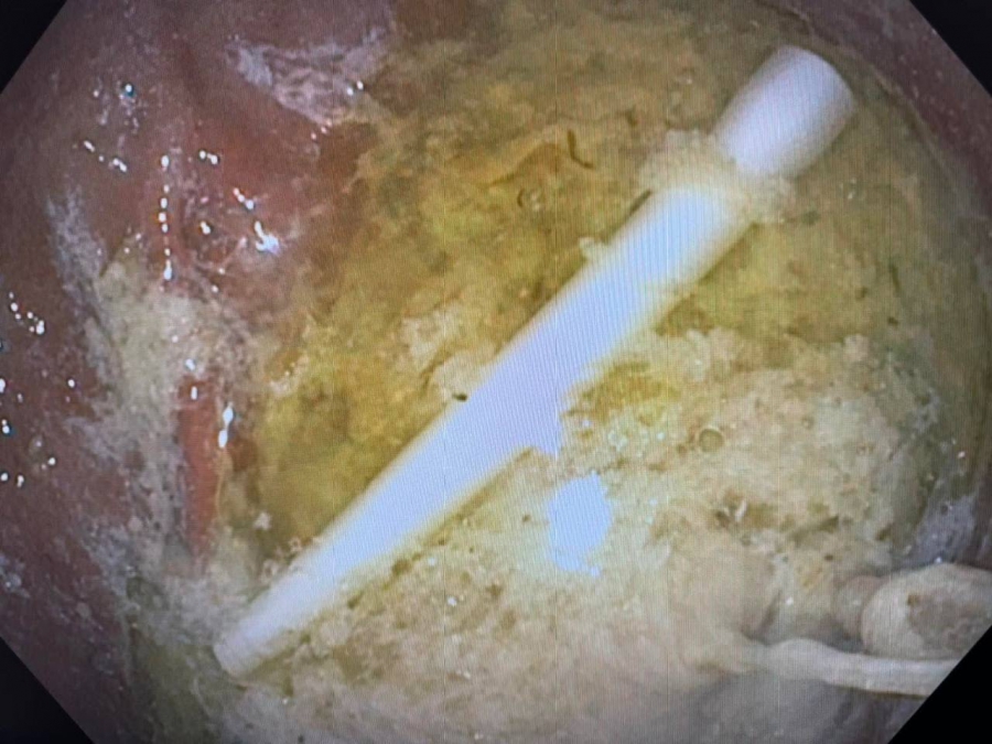 Саратовец проглотил трубку от ингалятора и попал на операционный стол