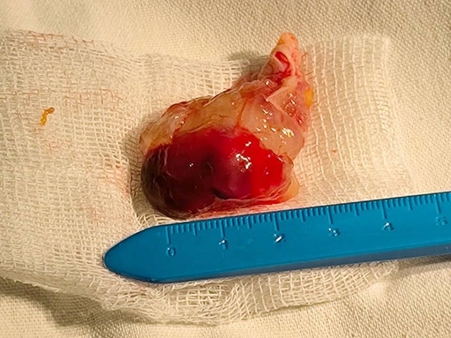 Саратовские хирурги удалили крупную миксому из сердца 85-летней пациентки