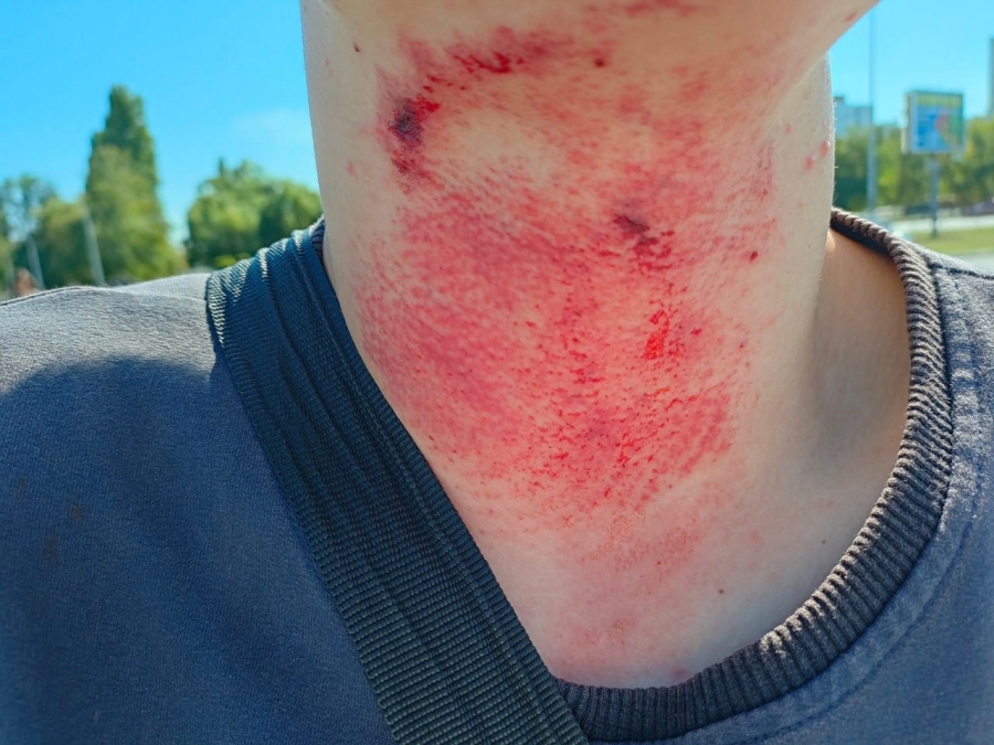 В Балакове самокатчик наехал на трос и получил травму шеи