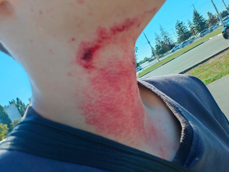 В Балакове самокатчик наехал на трос и получил травму шеи