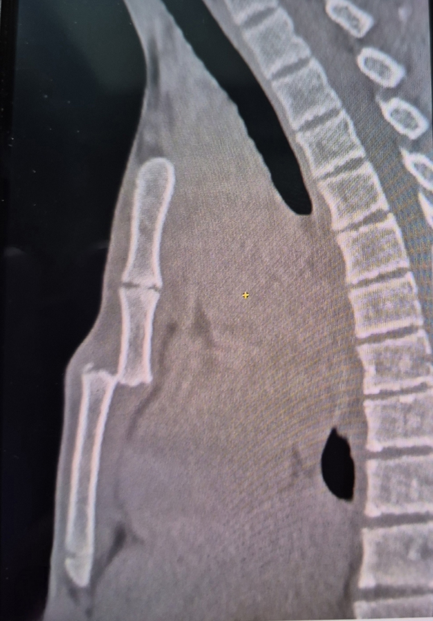 В Балакове подросток на турнике сломал себе грудину подбородком