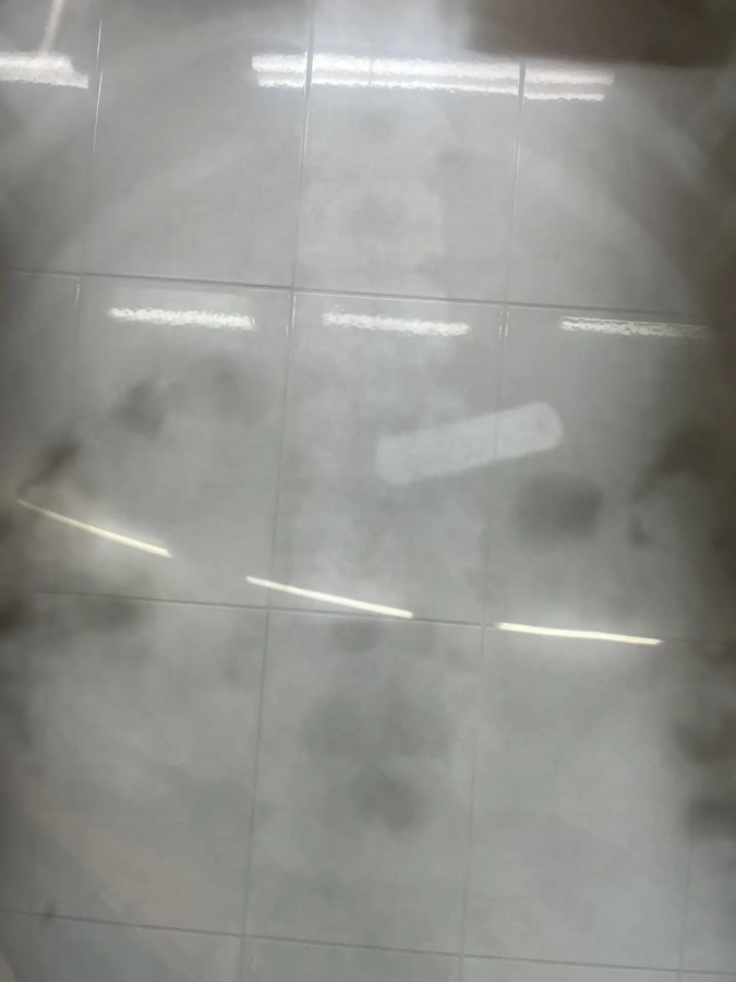 В Балакове врачи спасли двоих мальчиков с проглоченными батарейками